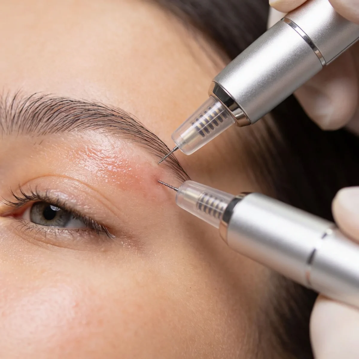 Micro-needling & RF